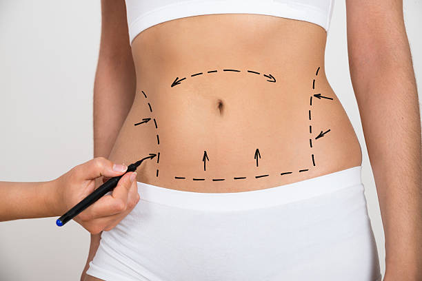 Fibrosis postquirúrgica, claves para prevenir una de las complicaciones más comunes después de procedimientos como la liposucción o la abdominoplastia Crigugia