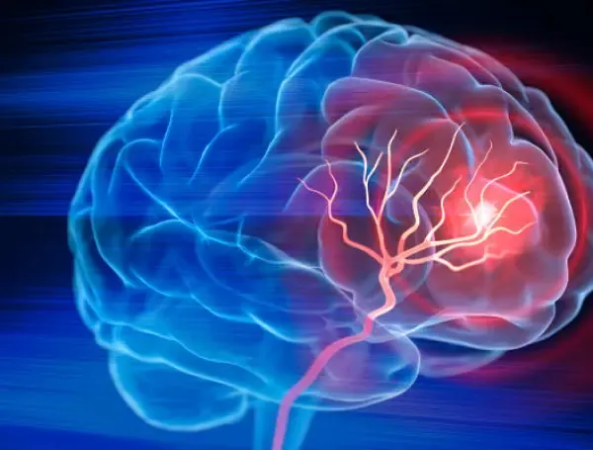 Estirarse el cuello para aliviar tensión casi le cuesta la vida: mujer en Estados Unidos sufre un ACV por un crujido rutinario La mayoría de los ACV e infartos ocurren en personas con un solo factor de riesgo.