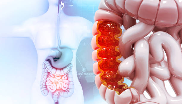Un virus adquirido en la niñez y silencioso durante años podría provocar cáncer de vejiga, según estudio Cáncer de colon