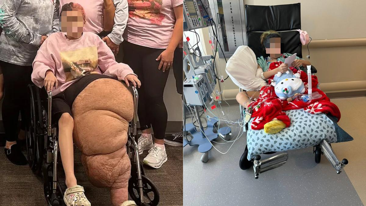 Adolescente padece una rara enfermedad que provocó el crecimiento anormal de una de sus piernas que llegó a pesar 79 kg Adolescente padece una rara enfermedad que provocó el crecimiento anormal de una de sus piernas que llegó a pesar 79 kg