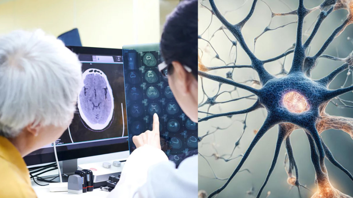 Eliminar una proteína podría reducir el daño cerebral por el Alzheimer, según nueva estrategia científica probada en laboratorio Eliminar una proteína podría reducir el daño cerebral por el Alzheimer, según nueva estrategia científica probada en laboratorio