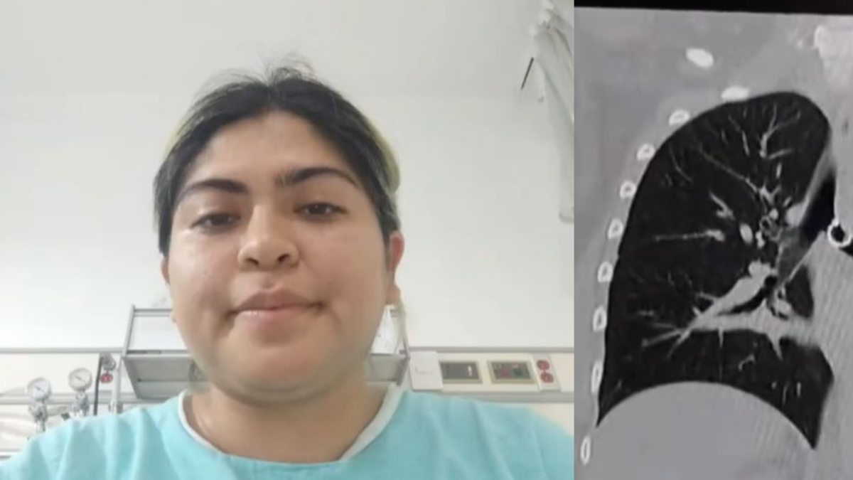 Se abrió un piercing en la nariz y tuvo que ser operada de urgencias luego de que esté llegara a su pulmón Se abrió un piercing en la nariz y tuvo que ser operada de urgencias luego de que esté llegara a su pulmón