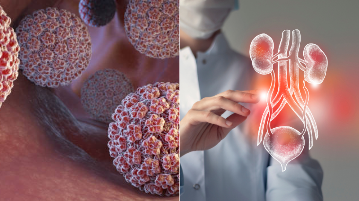 Un virus adquirido en la niñez y silencioso durante años podría provocar cáncer de vejiga, según estudio Un virus adquirido en la niñez y silencioso durante años podría provocar cáncer de vejiga, según estudio