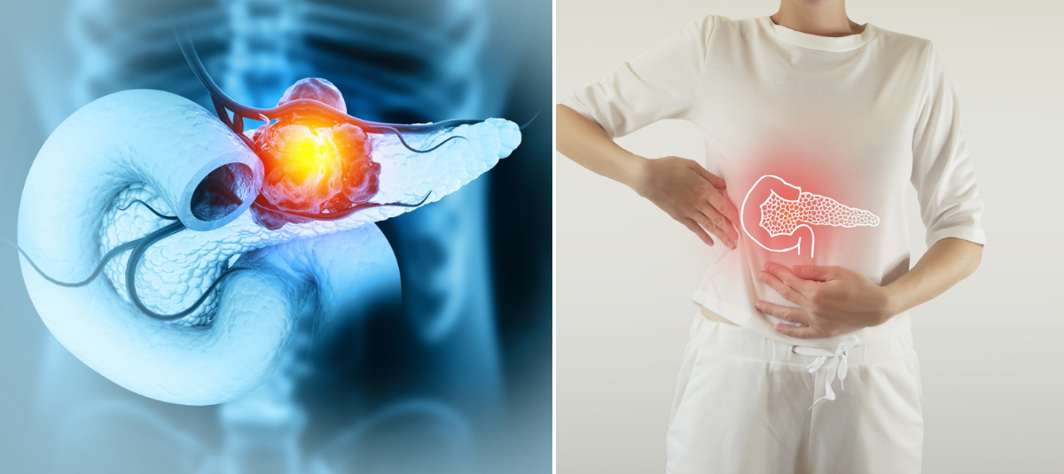 Científicos españoles logran eliminar el cáncer de páncreas combinando estos tres medicamentos Cáncer de páncreas