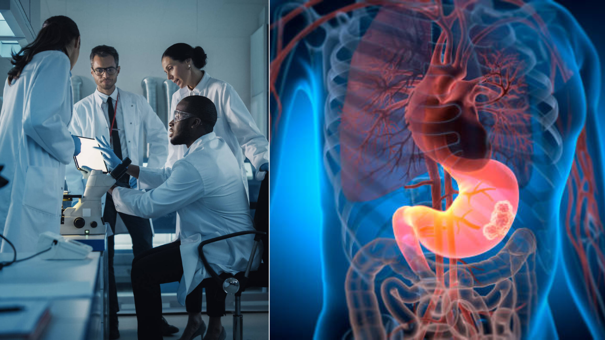 Expertos establecen un plazo máximo para realizar una endoscopia ante la sospecha de cáncer gástrico: ¿cuánto tiempo hay para actuar? Cáncer de estómago