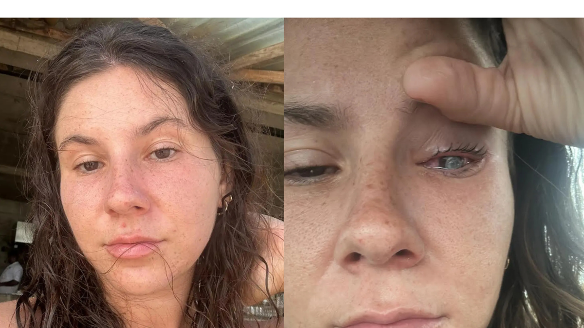 Pensó que su dolor de ojo era normal y descubrió una peligrosa bacteria Pensó que su dolor de ojo era normal y descubrió una peligrosa bacteria