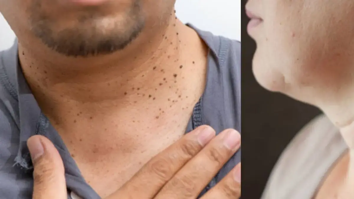 ¿Qué pasa si elimina las verrugas del cuerpo con un cabello o un hilo? Esto dicen los expertos. ¿Qué pasa si elimina las verrugas del cuerpo con un cabello o un hilo? Esto dicen los expertos.